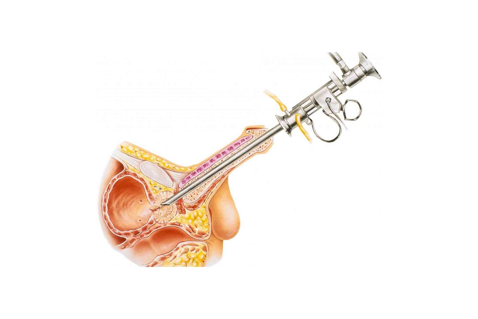 What Are The Treatment Options For Bph — Practical Tips and Expert