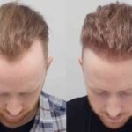 Hair Transplant Turkey