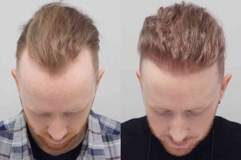 Hair Transplant Turkey